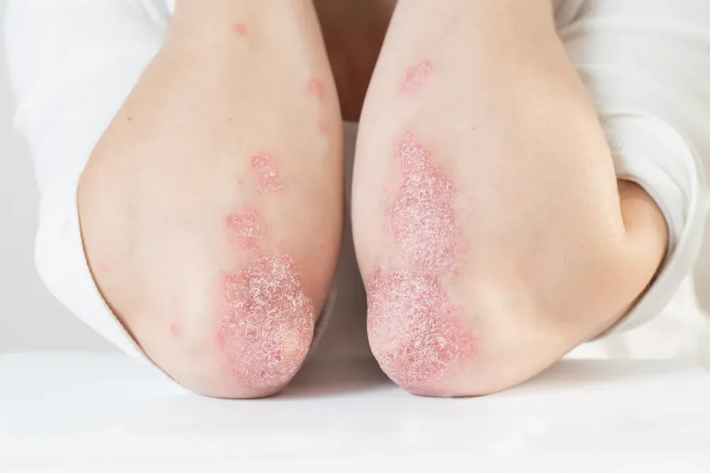Psoriasis à Bagnols-sur-Cèze